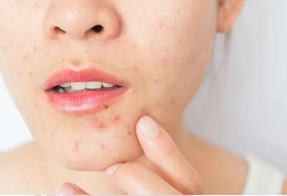 Acne Breakouts in Monsoon Here's Your Survival Guide
