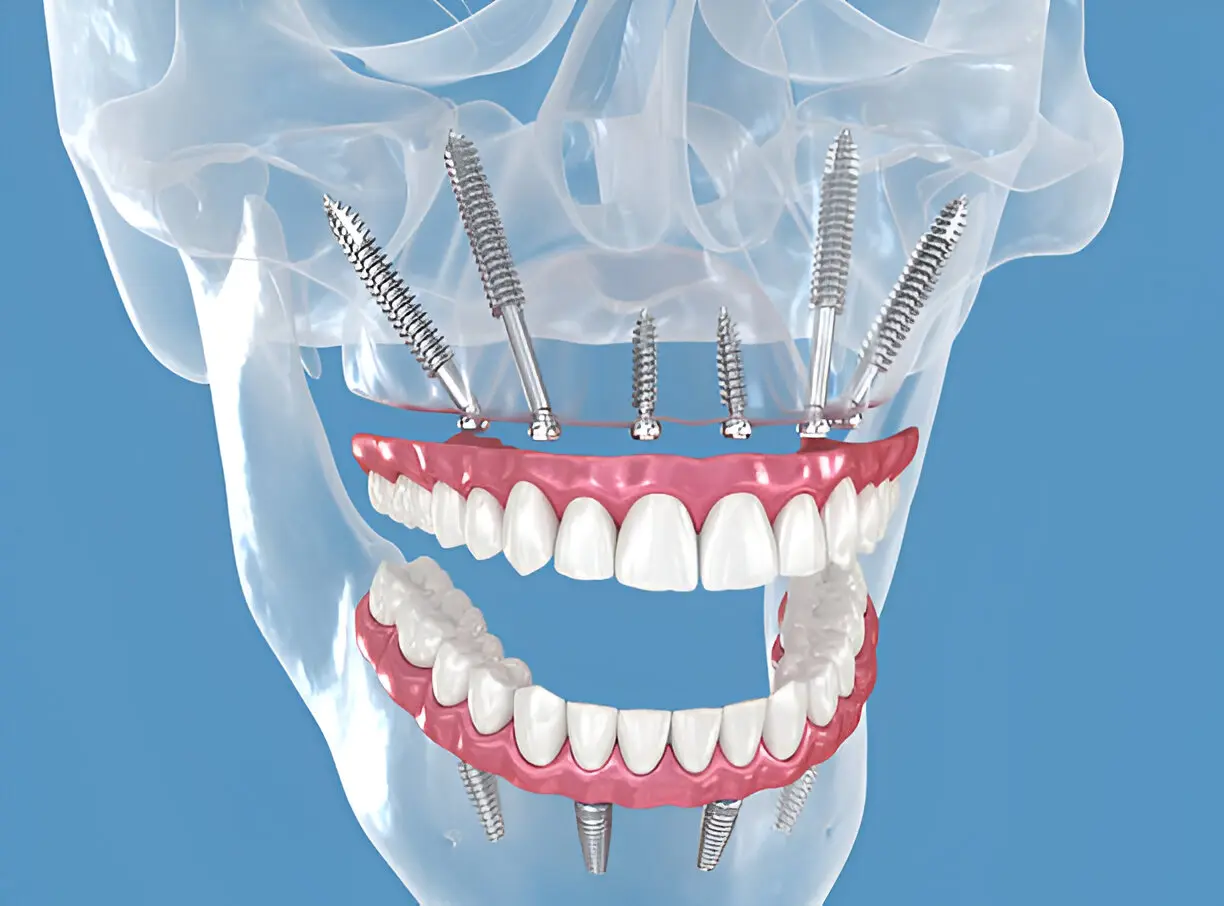 All-on-6 Dental Implants Fix Your Whole Smile Permanently