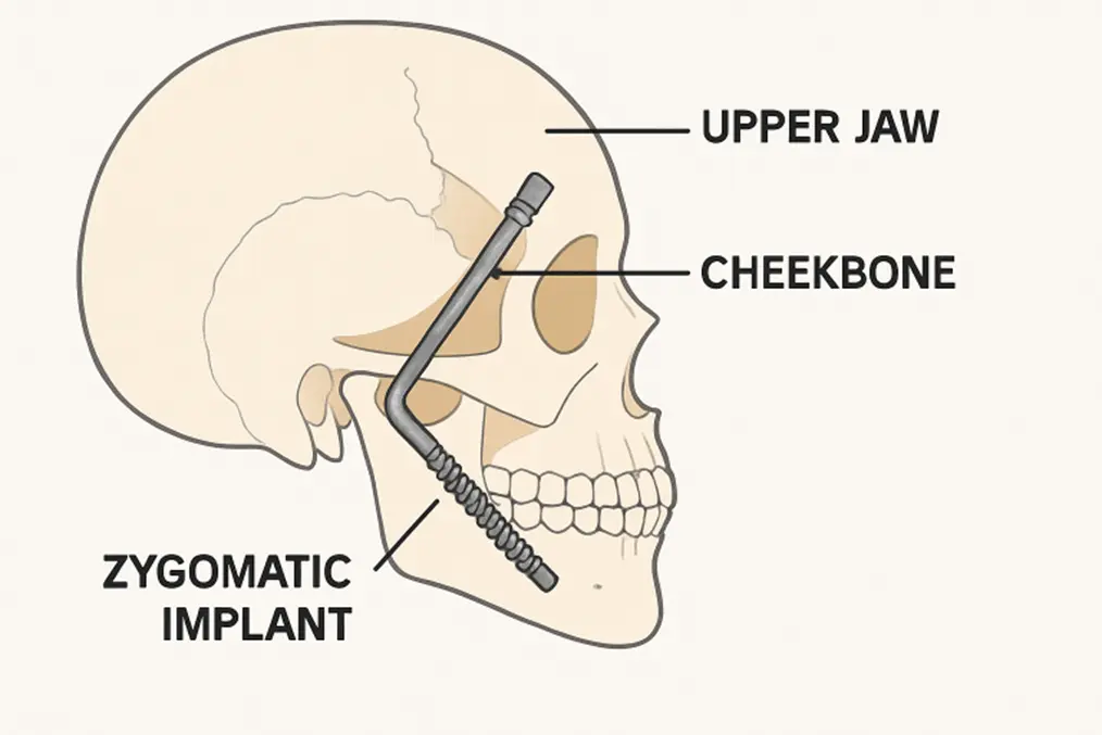 A Modern Guide to Zygomatic Dental Implants